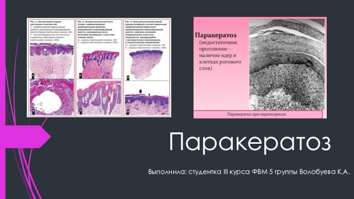 Паракератоз Выполнила: студентка III курса ФВМ 5 группы Волобуева К.А.