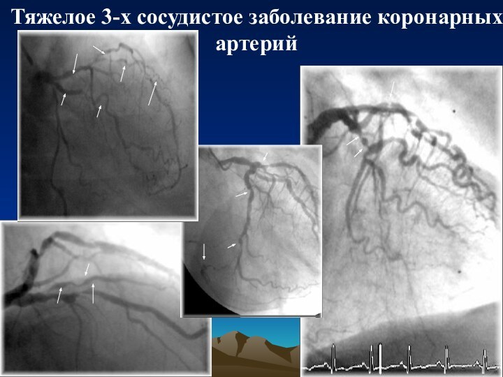 Расширение коронарных артерий нитроглицерин