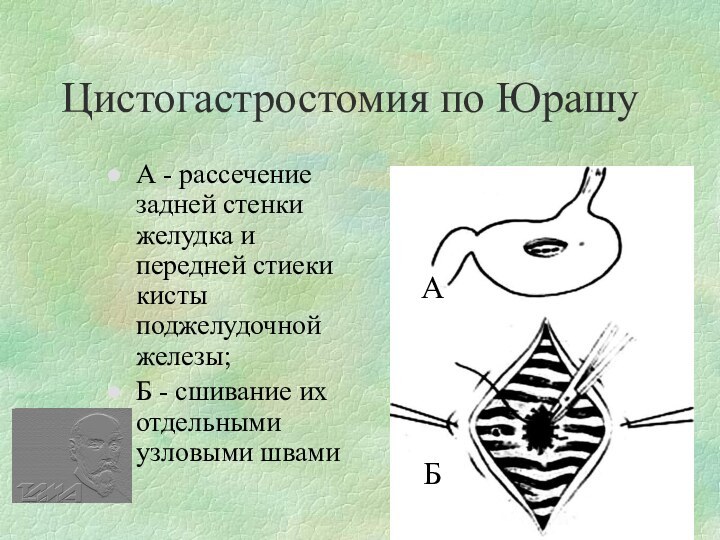 Цистогастростомия по ЮрашуА - рассечение задней стенки желудка и передней стиеки кисты