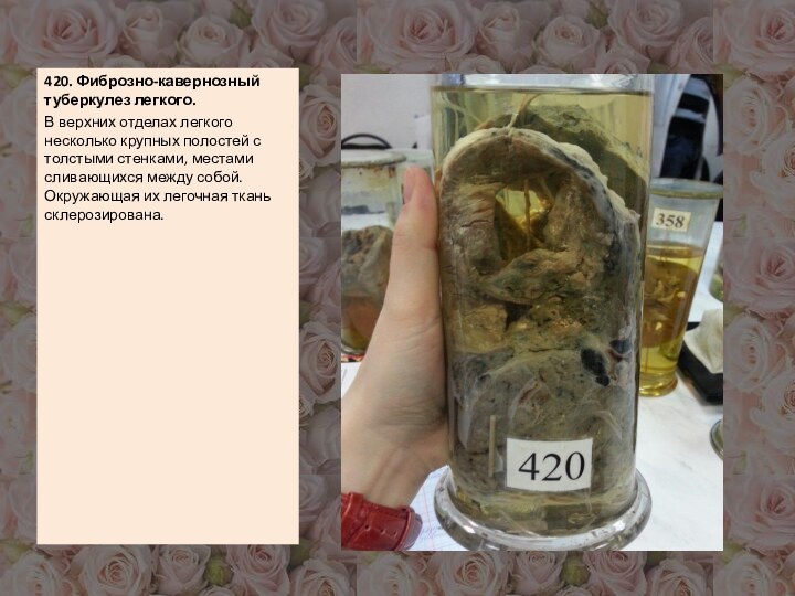 420. Фиброзно-кавернозный туберкулез легкого.В верхних отделах легкого несколько крупных полостей с толстыми