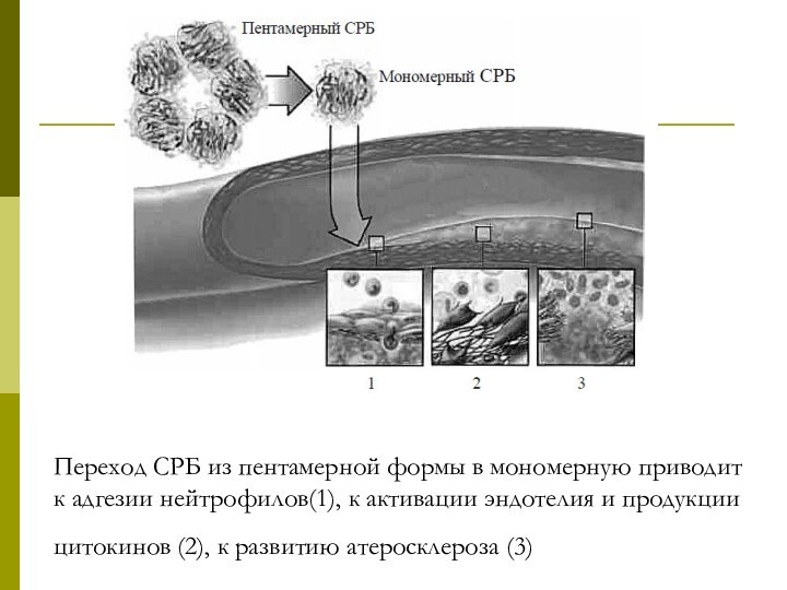 Переход СРБ из пентамерной формы в мономерную приводит к адгезии нейтрофилов(1), к
