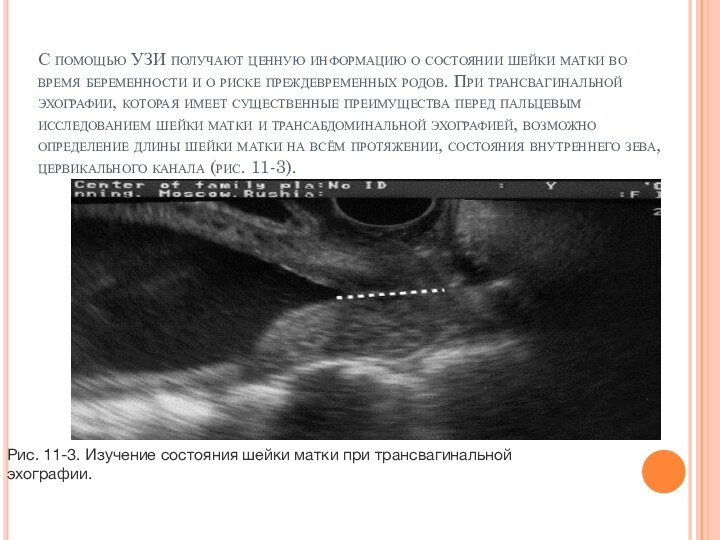 С помощью УЗИ получают ценную информацию о состоянии шейки матки во время