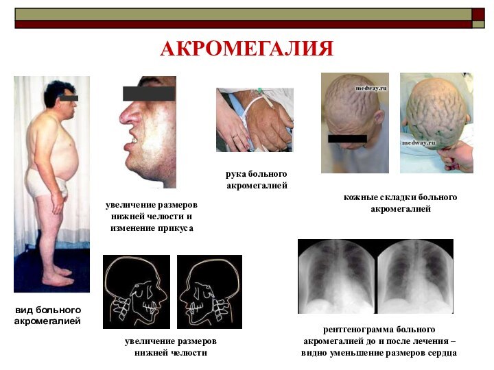 АКРОМЕГАЛИЯвид больного акромегалиейувеличение размеров нижней челюстиувеличение размеров нижней челюсти и изменение прикусарука