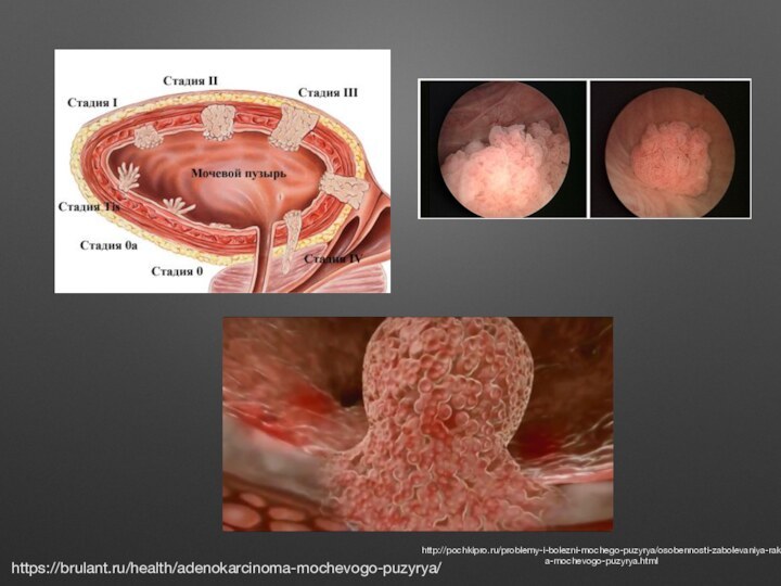 https://brulant.ru/health/adenokarcinoma-mochevogo-puzyrya/http://pochkipro.ru/problemy-i-bolezni-mochego-puzyrya/osobennosti-zabolevaniya-raka-mochevogo-puzyrya.html