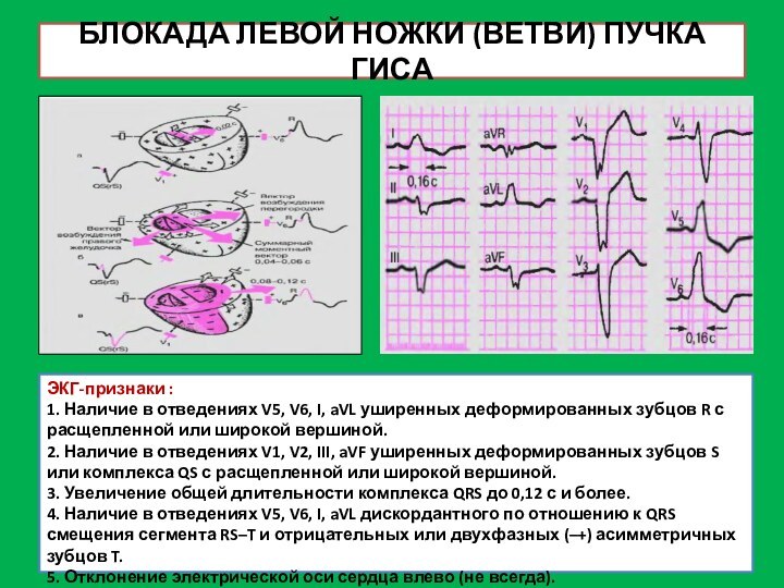 БЛОКАДА ЛЕВОЙ НОЖКИ (ВЕТВИ) ПУЧКА ГИСАЭКГ-признаки :1. Наличие в отведениях V5, V6,