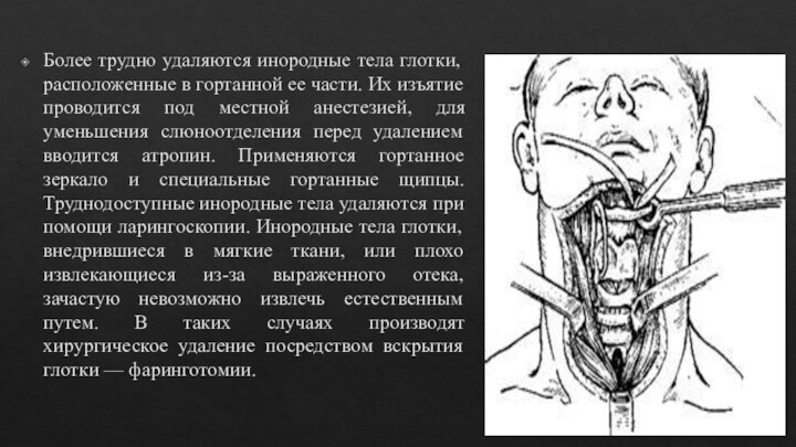 Более трудно удаляются инородные тела глотки, расположенные в гортанной ее части. Их