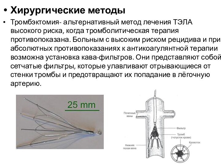 Хирургические методыТромбэктомия- альтернативный метод лечения ТЭЛА высокого риска, когда тромболитическая терапия противопоказана.