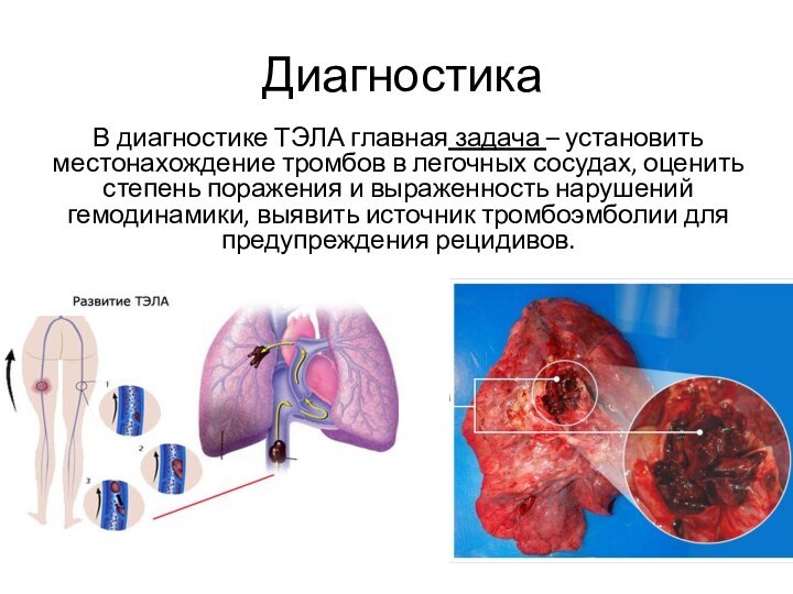 ДиагностикаВ диагностике ТЭЛА главная задача – установить местонахождение тромбов в легочных сосудах,