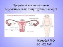 Прервавшаяся внематочная беременность по типу трубного аборта
