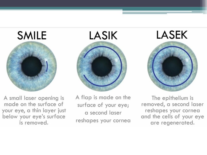Отличия лазерной коррекции зрения