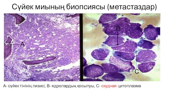 Сүйек миының биопсиясы (метастаздар)А- сүйек тінінің лизисі, В- ядролардың қосылуы, С- скудная цитоплазмаАВС