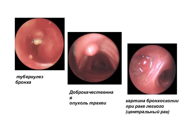  туберкулез бронхаДоброкачественная опухоль трахеикартина бронхоскопии при раке легкого (центральный рак)