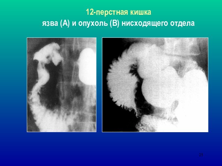 12-перстная кишкаязва (А) и опухоль (В) нисходящего отдела