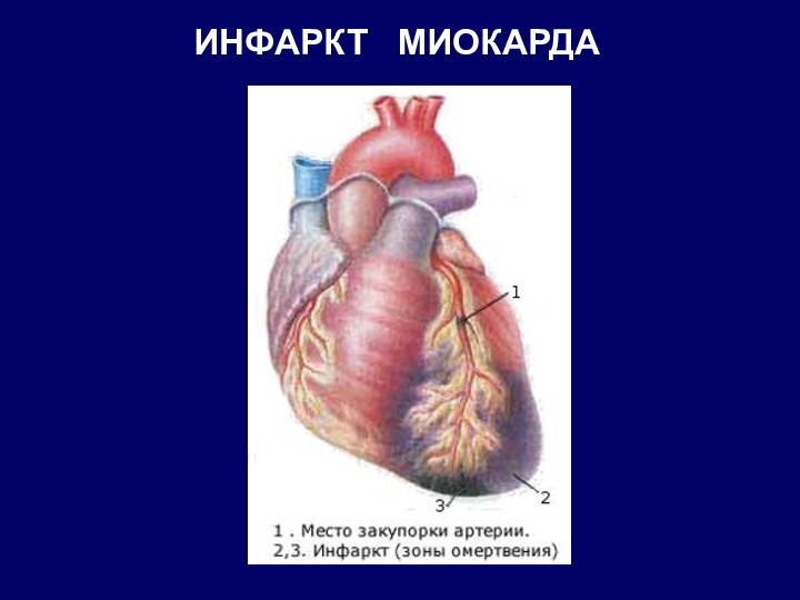 ИНФАРКТ  МИОКАРДА