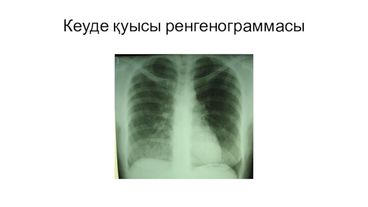 Кеуде қуысы ренгенограммасы