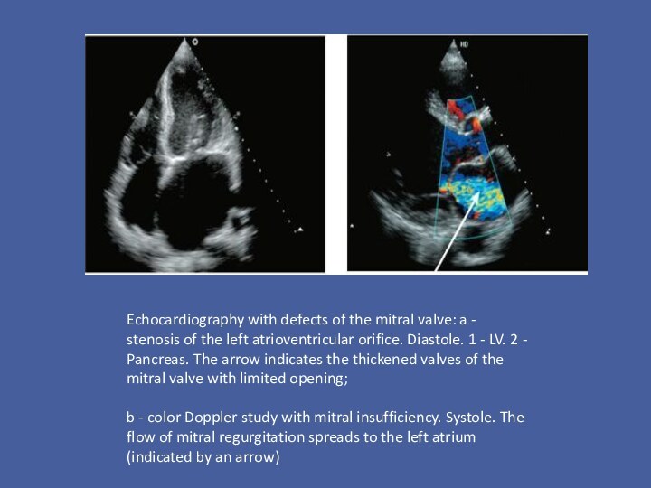 Echocardiography with defects of the mitral valve: a - stenosis of the
