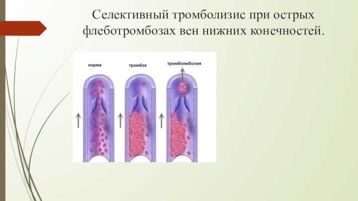Селективный тромболизис при острых флеботромбозах вен нижних конечностей.