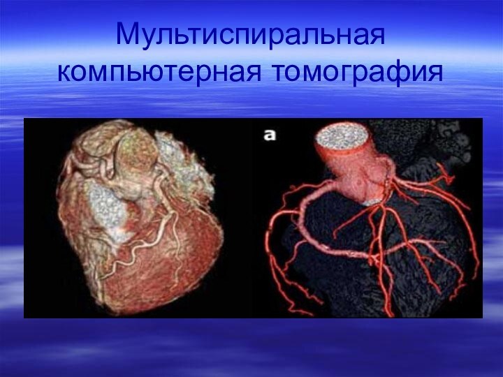 Мультиспиральная компьютерная томография