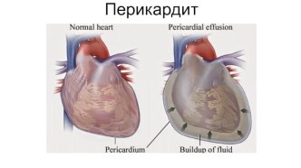 Перикардит. Эксудативный перикардит