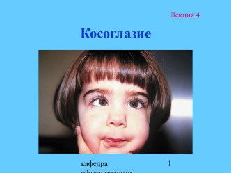 Косоглазие