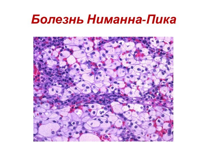 Болезнь Ниманна-Пика