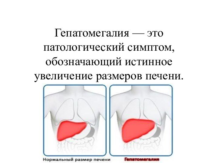 Гепатомегалия — это патологический симптом, обозначающий истинное увеличение размеров печени.