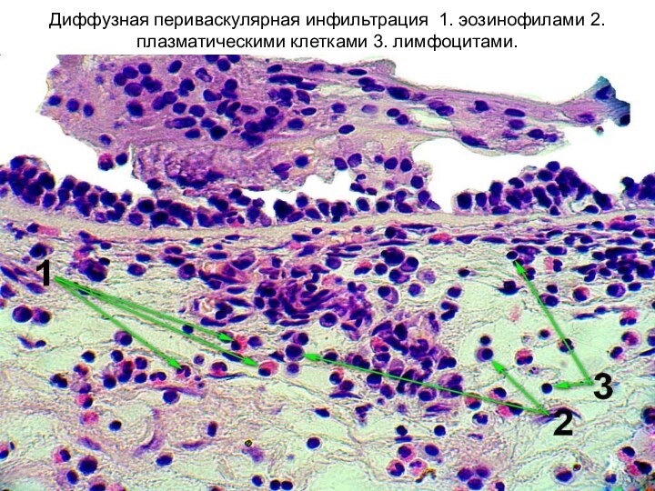 Диффузная периваскулярная инфильтрация 1. эозинофилами 2. плазматическими клетками 3. лимфоцитами.