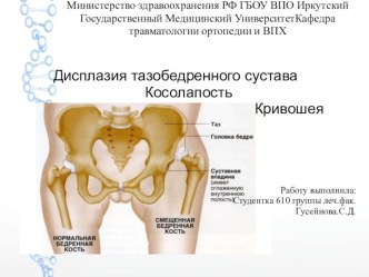 Дисплазия тазобедренного сустава. Косолапость. Кривошея