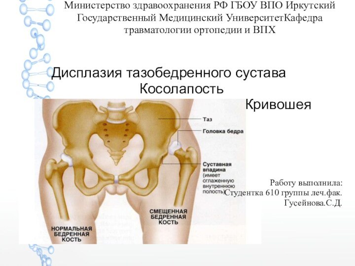 Министерство здравоохранения РФ ГБОУ ВПО Иркутский Государственный Медицинский УниверситетКафедра травматологии ортопедии и