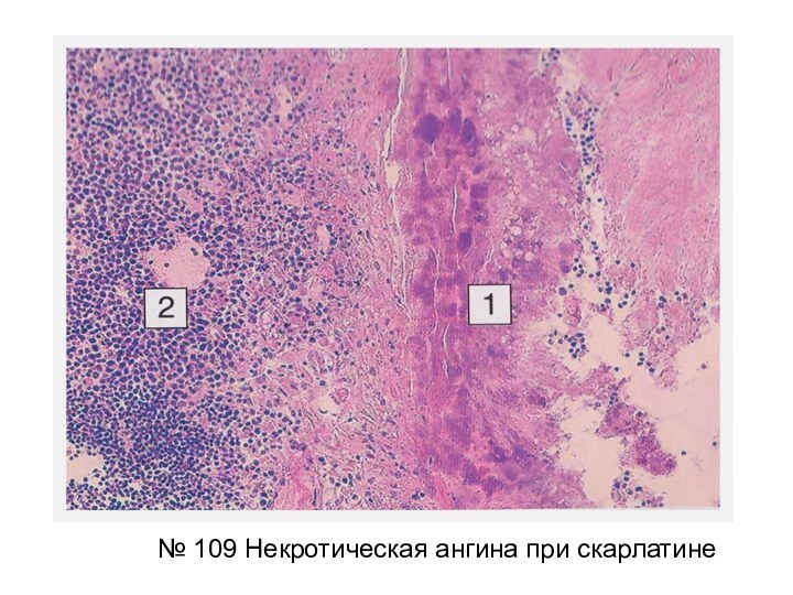 № 109 Некротическая ангина при скарлатине