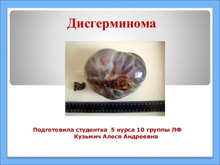 Дисгерминома Подготовила студентка 5 курса 10 группы ЛФКузьмич Алеся Андреевна