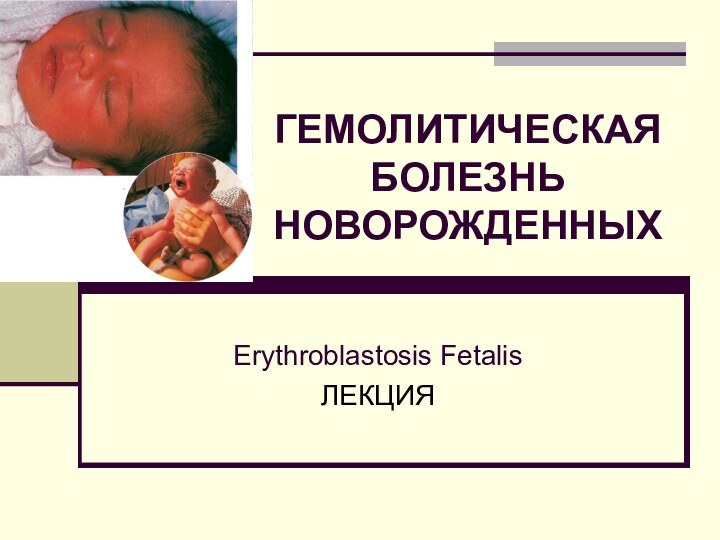 ГЕМОЛИТИЧЕСКАЯ БОЛЕЗНЬ НОВОРОЖДЕННЫХErythroblastosis FetalisЛЕКЦИЯ