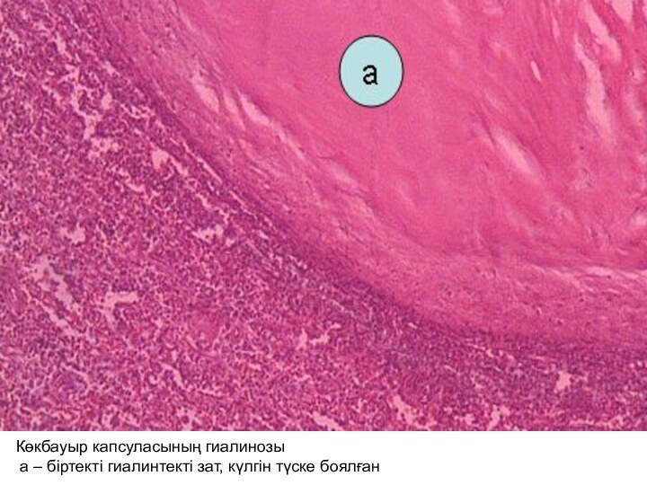 Көкбауыр капсуласының гиалинозы а – біртекті гиалинтекті зат, күлгін түске боялған