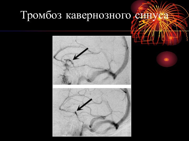 Тромбоз кавернозного синуса