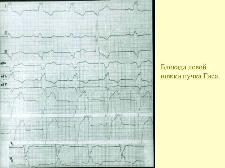 Блокада левой ножки пучка Гиса.
