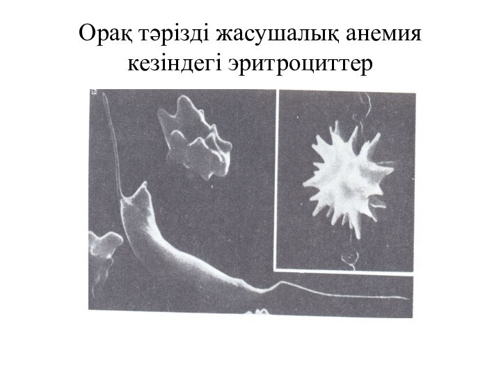 Орақ тәрізді жасушалық анемия кезіндегі эритроциттер