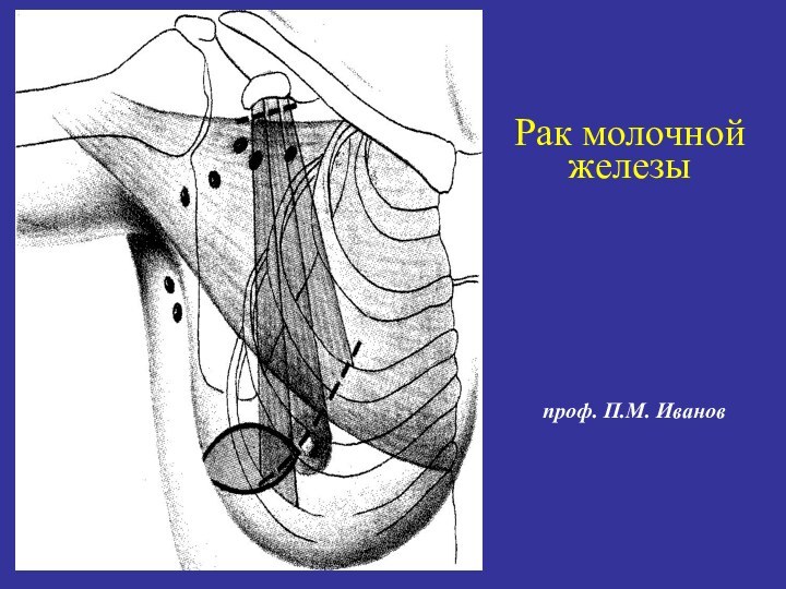 проф. П.М. ИвановРак молочнойжелезы