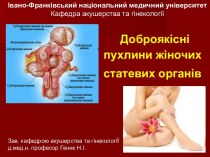 Доброякісні пухлини жіночих статевих органів