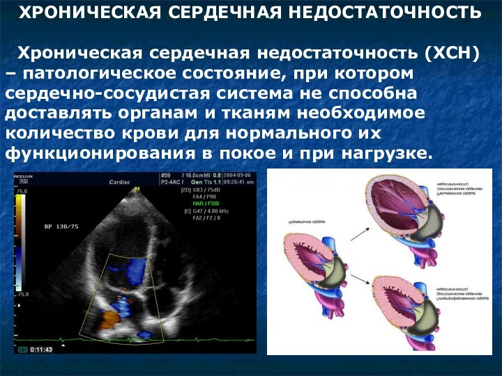 ХРОНИЧЕСКАЯ СЕРДЕЧНАЯ НЕДОСТАТОЧНОСТЬХроническая сердечная недостаточность (ХСН) – патологическое состояние, при котором сердечно-сосудистая