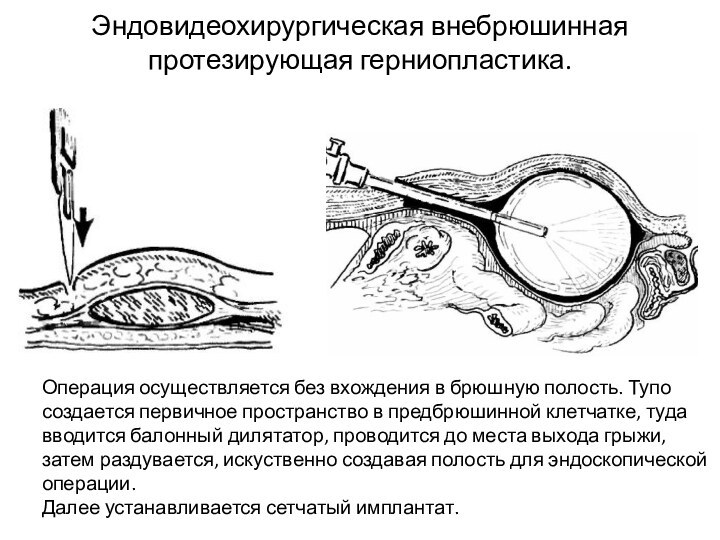 Эндовидеохирургическая внебрюшинная протезирующая герниопластика.Операция осуществляется без вхождения в брюшную полость. Тупо создается