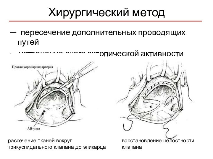 Хирургический метод — пересечение дополнительных проводящих путей— устранение очага эктопической активностирассечение тканей