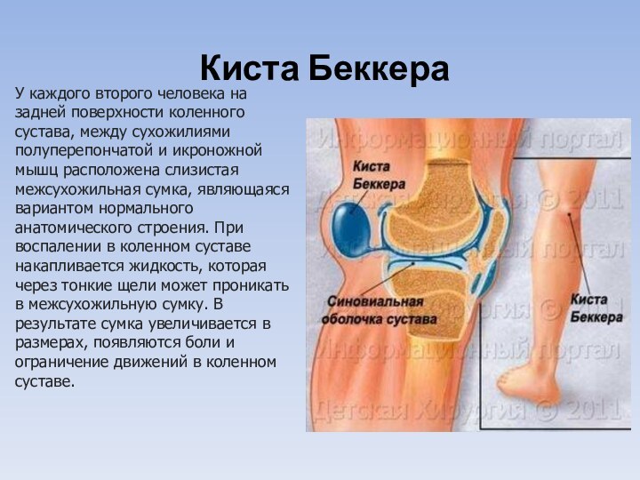 Киста БеккераУ каждого второго человека на задней поверхности коленного сустава, между сухожилиями