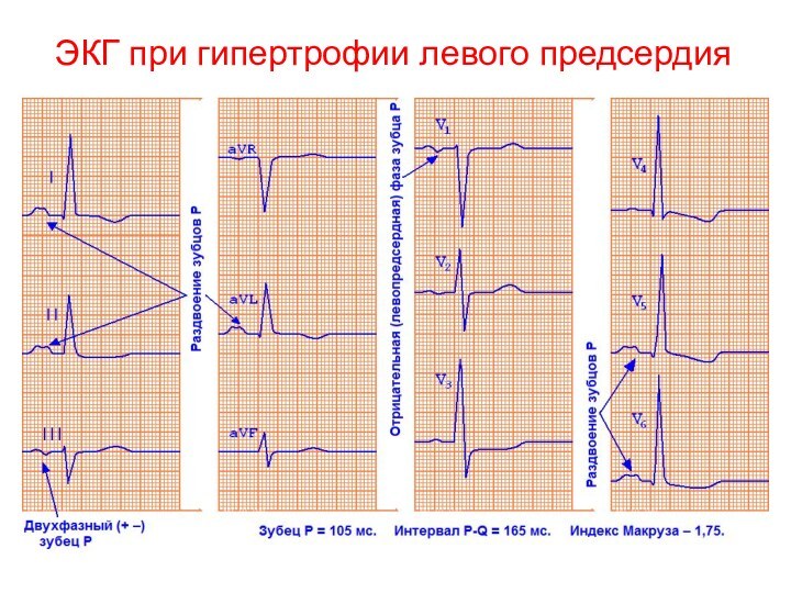 ЭКГ при гипертрофии левого предсердия