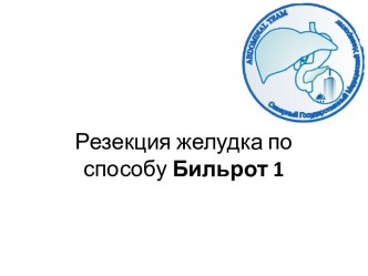 Резекция желудка по способу Бильрот 1