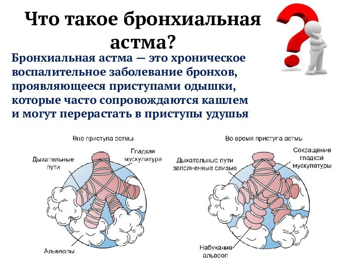 Что такое бронхиальная астма?Бронхиальная астма — это хроническое воспалительное заболевание бронхов, проявляющееся