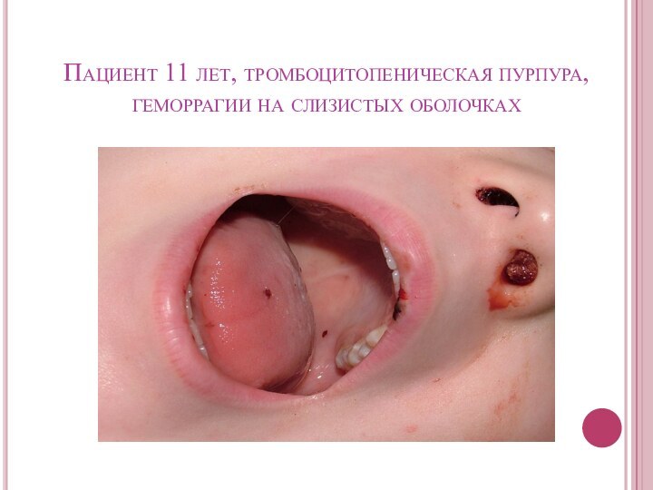 Пациент 11 лет, тромбоцитопеническая пурпура, геморрагии на слизистых оболочках