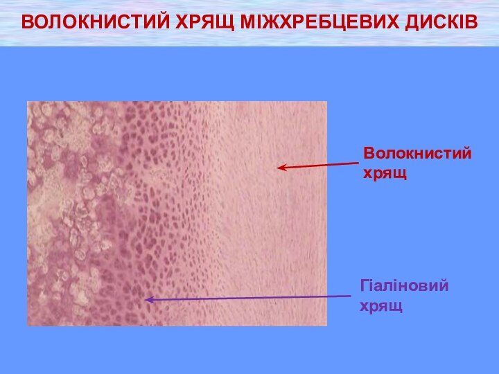 ВОЛОКНИСТИЙ ХРЯЩ МІЖХРЕБЦЕВИХ ДИСКІВ    Волокнистий хрящГіаліновий хрящ