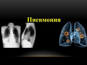 Пневмония. Клинические проявления пневмонии