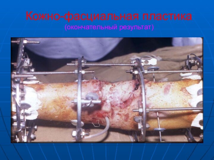 Кожно-фасциальная пластика (окончательный результат)