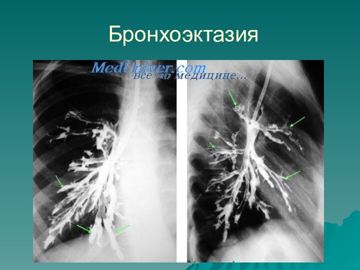 Приобретенные бронхоэктазы